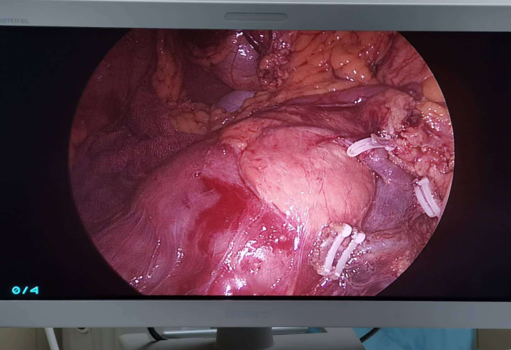 腹腔镜结肠癌伴肝转移一期切除手术