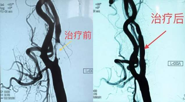 颈动脉狭窄支架植入术