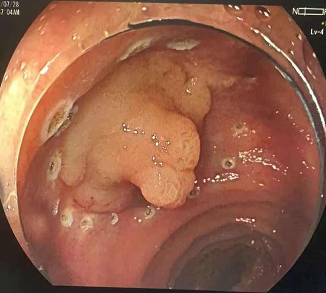 巨大直肠侧向发育型肿瘤（LST）患者实施内镜下粘膜剥离术(E