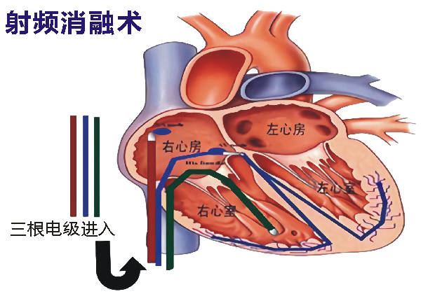 心导管射频消融术