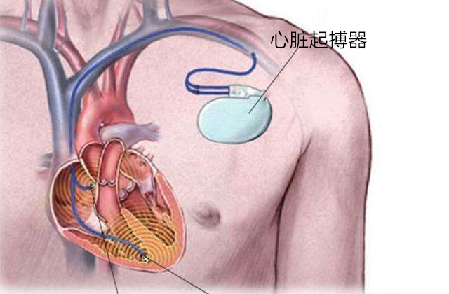 四川友谊医院开展首届心脏起搏心友会暨第二届心肺复苏成“救”你我科普小课堂