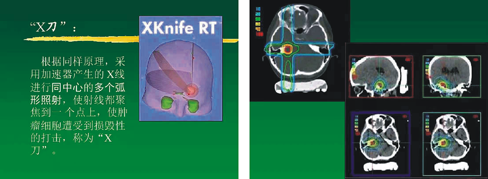 立体定向放射治疗（X刀、SBRT）