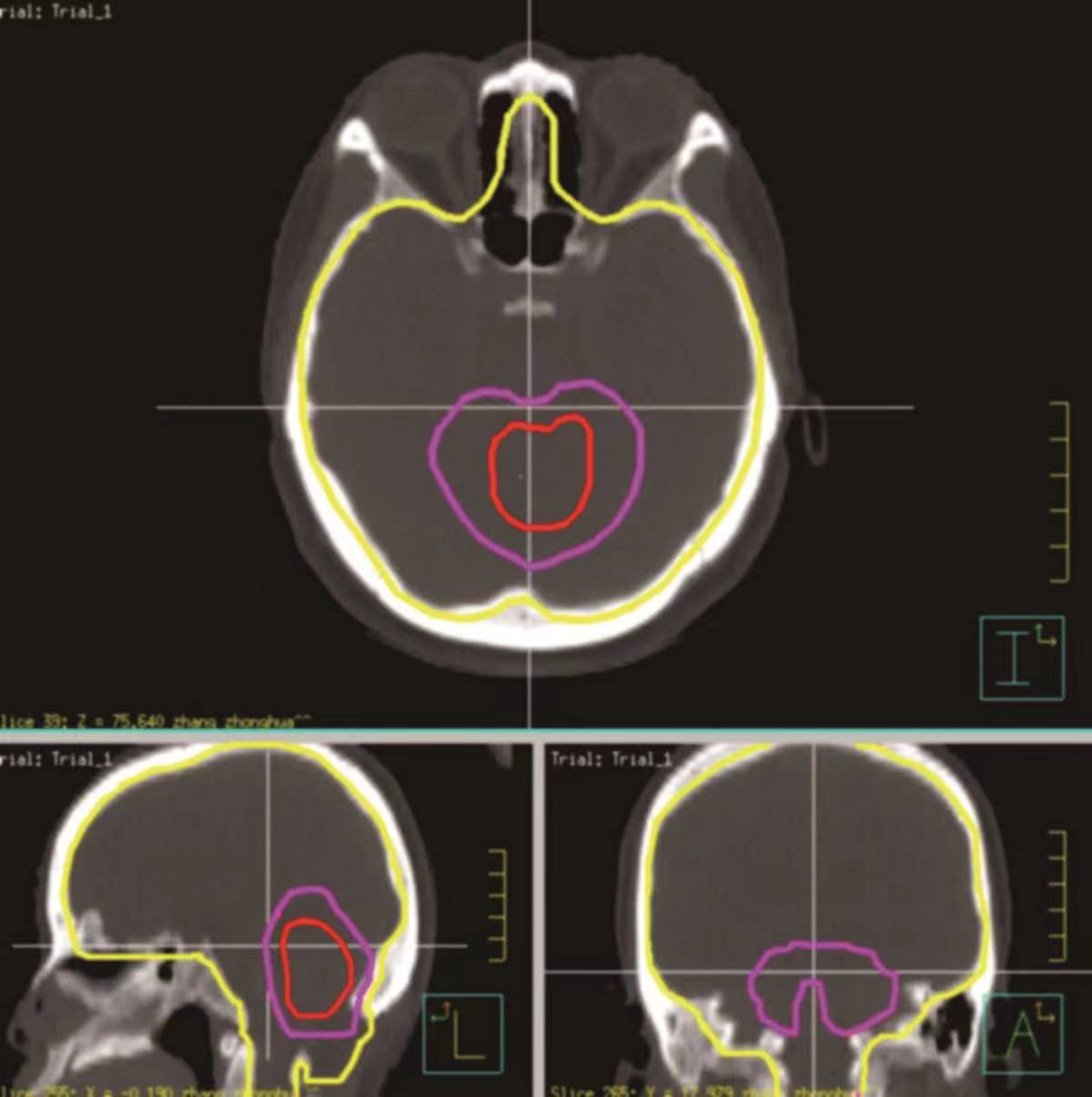 第四脑室髓母细胞瘤术后全中枢照射（TOMO技术）