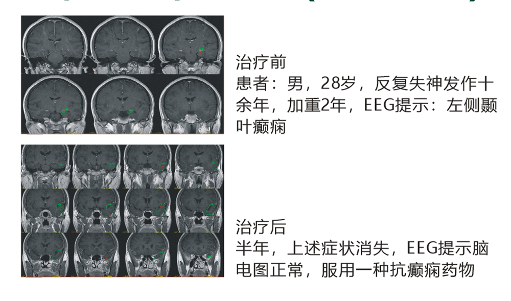 药物难治性癫痫（颞叶癫痫）