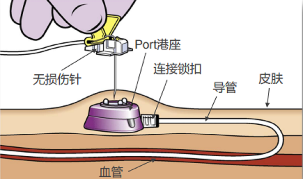 为什么建议长期化疗的患者使用输液港