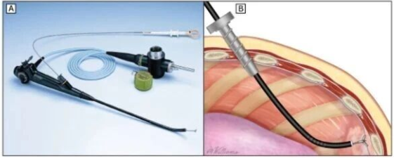 咳嗽、咳痰？不明原因胸腔积液？内科胸腔镜：一镜揭开肺部“谜案”